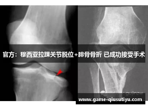 官方：穆西亚拉踝关节脱位+腓骨骨折 已成功接受手术